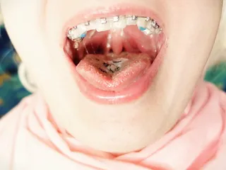 Braces Fetish - Asmr Video Of Eating Mukbang… free video